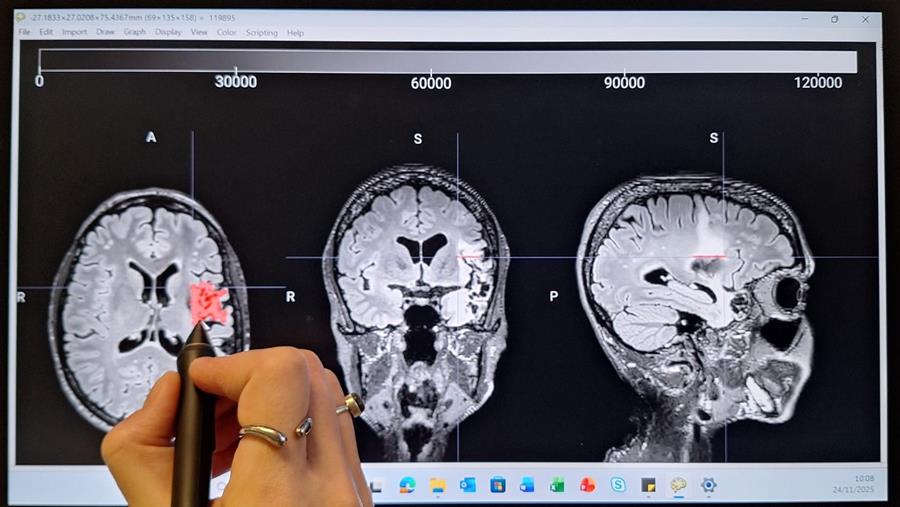 L'état général du cerveau et le niveau d'instruction influencent l'impact d'un AVC